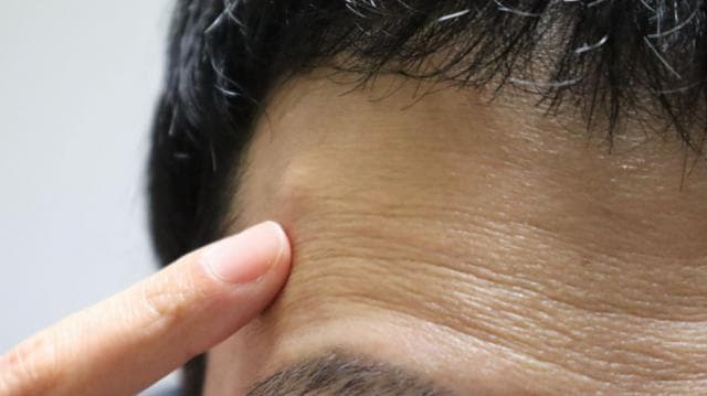 মানুষের শরীরের যেকোন স্থানেই লাইপোমা হতে পারে