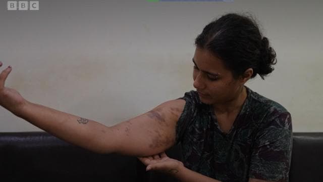শরীরে আঘাতের চিহ্ন দেখাচ্ছেন নাদিয়া নামে এক শিক্ষার্থী